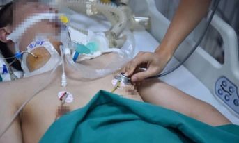 Phải lọc máu, tính mạng bị đe dọa vì sốt xuất huyết