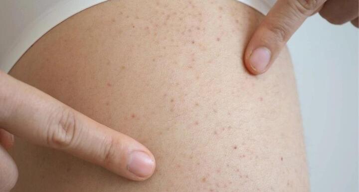 Cô gái 19 tuổi mắc chứng rối loạn máu hiếm gặp sau khi nổi ban đỏ