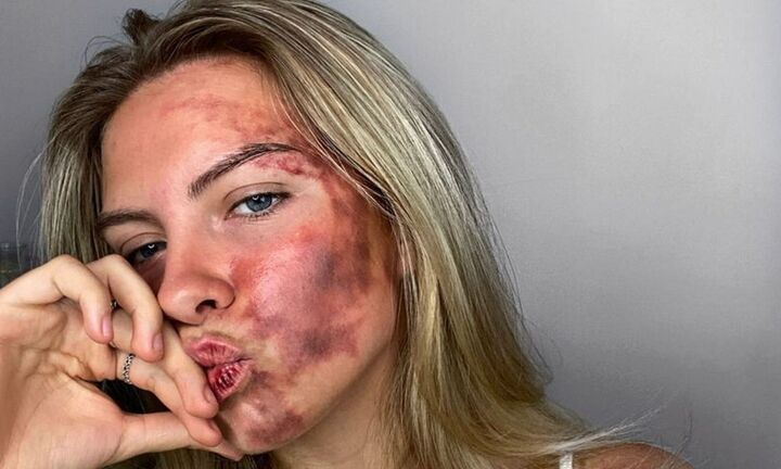Mắc bệnh lạ gây nên vết bầm khắp mặt, cô gái trẻ có quyết định đáng ngưỡng mộ