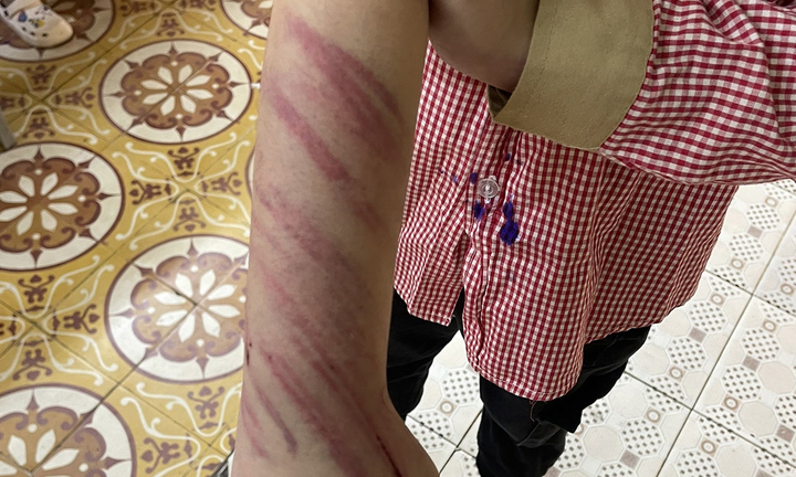 Hải Phòng: Học sinh lớp 2 nghi bị bạn trai của mẹ đánh đập, bầm tím khắp người