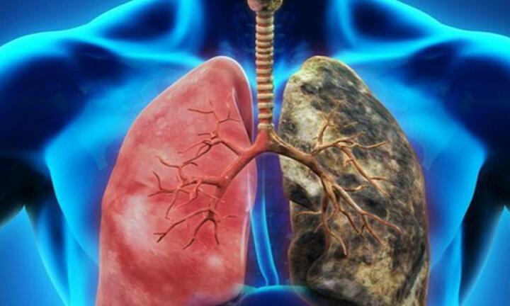 Những người thuộc nhóm nguy cơ cao mắc ung thư phổi
