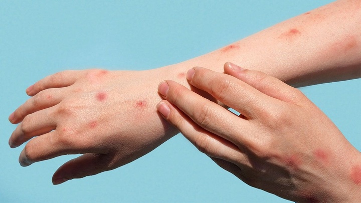 Bộ Y tế xếp đậu mùa khỉ vào bệnh truyền nhiễm nhóm B