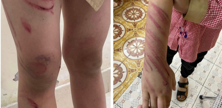 Lời khai của cha dượng đánh bé trai 8 tuổi bầm tím khắp người