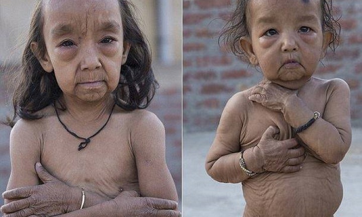 Cuộc sống của hai đứa trẻ sinh ra với gương mặt già nua hơn cả bố mẹ