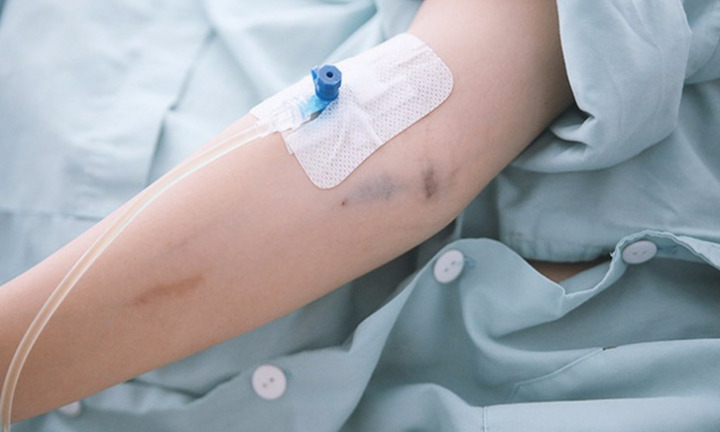 Nhập viện vì tự ý truyền dịch chữa sốt xuất huyết