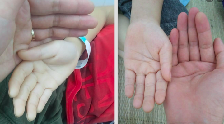 Bé 10 tuổi da xanh, chóng mặt kéo dài, cha mẹ ngỡ ngàng khi biết nguyên nhân