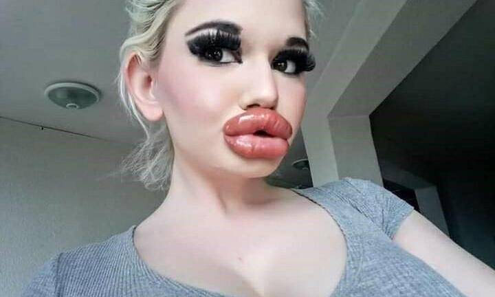 Cô gái tiêm môi 32 lần bất chấp nguy hiểm tính mạng