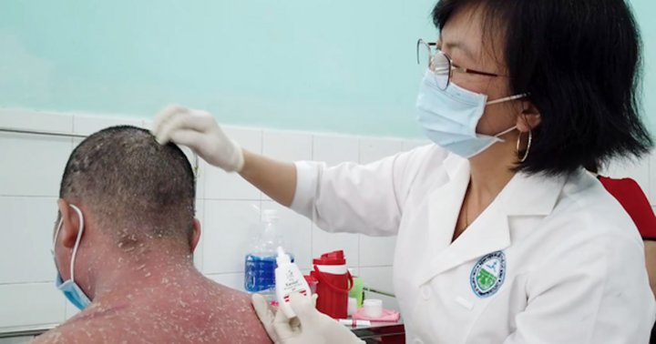 Nhiều trường hợp nhập viện do sử dụng thuốc chữa vảy nến trên mạng