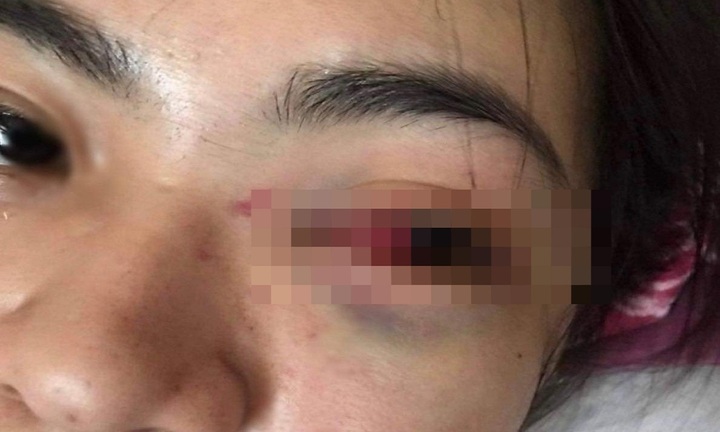 Hà Tĩnh: Nữ sinh lớp 11 bị nhóm bạn đánh tụ máu mắt