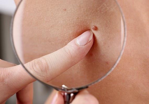 Phát hiện ung thư từ nốt ruồi có dấu hiệu bất thường