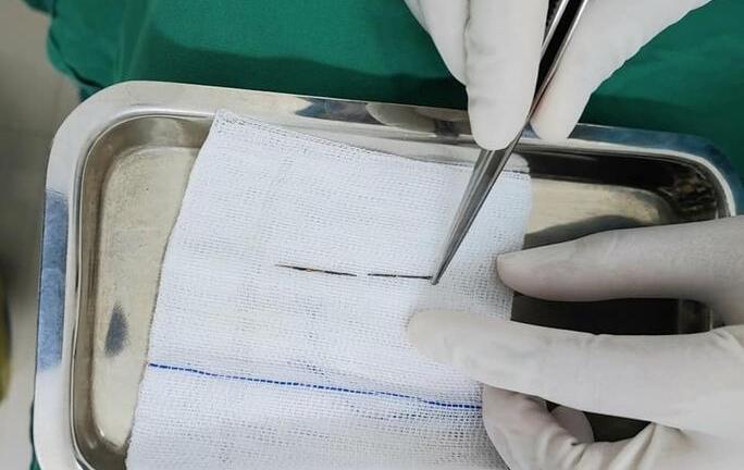 Bác sĩ kịp thời gắp kim may quần áo trong phổi bé trai 4 tuổi