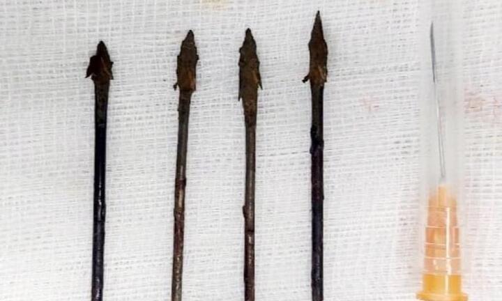 Bé trai 11 tuổi bị nhiều mũi tên sắt găm sâu vào mặt