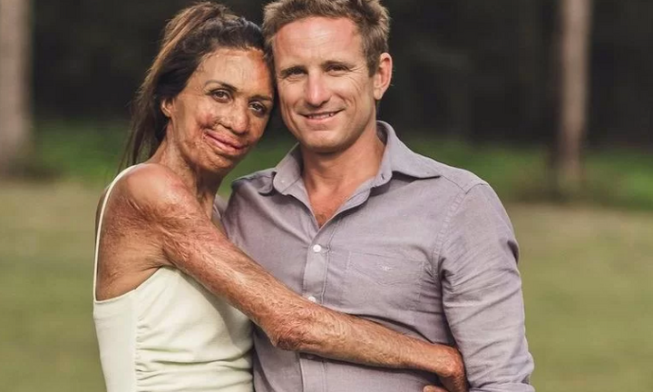 Bị biến dạng vì bỏng, cô gái vẫn được ngưỡng mộ bởi chuyện tình đẹp như mơ