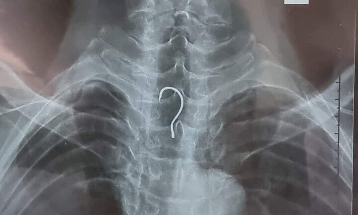 Cụ ông 83 tuổi mắc lưỡi câu trong bụng