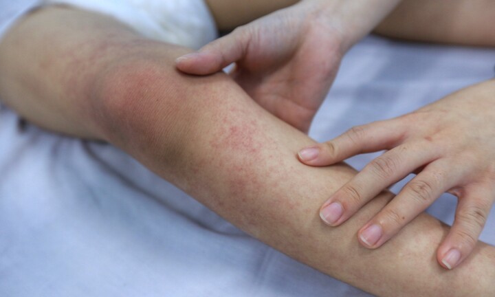 Cô gái 19 tuổi ho ra máu liên tục vì sốt xuất huyết