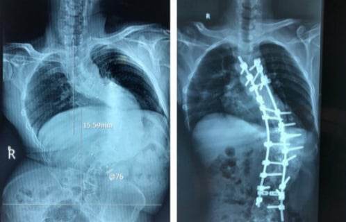 Phẫu thuật lấy lại hình dạng cho người đàn ông bị gù vẹo cột sống hơn chục năm