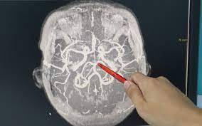 Người phụ nữ nhận tin bị u não dù không có triệu chứng cảnh báo