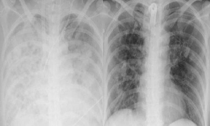 Lạm dụng corticoid tự điều trị cúm, người phụ nữ viêm phổi, suy đa tạng