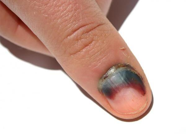 Nhìn móng tay chẩn đoán bệnh