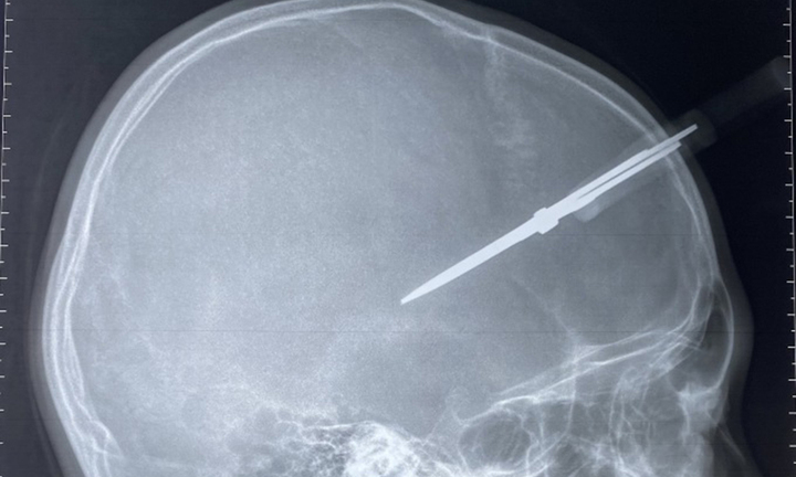 Cứu bé trai bị kéo thủ công đâm thủng hộp sọ