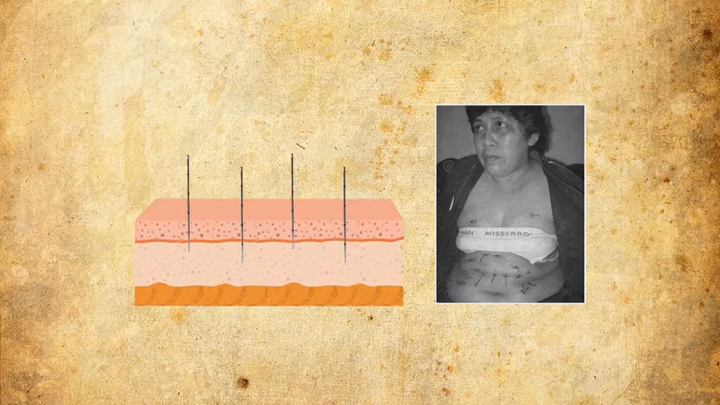 Bí ẩn chưa lời giải: Người phụ nữ mọc dây thép dài xuyên qua bụng