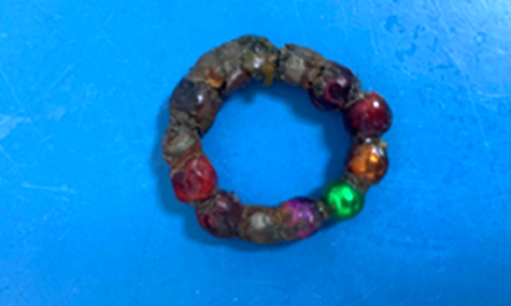 Nuốt 14 viên nam châm, bé trai 3 tuổi bị thủng ruột