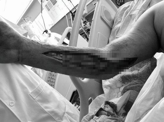 Căn bệnh khiến chàng trai 25 tuổi phải đoạn chi để giữ mạng sống