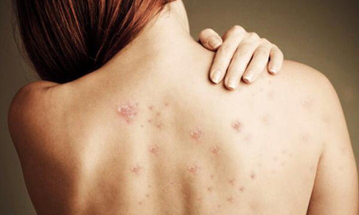 9 cách trị mụn lưng hiệu quả tại nhà, bạn nên biết