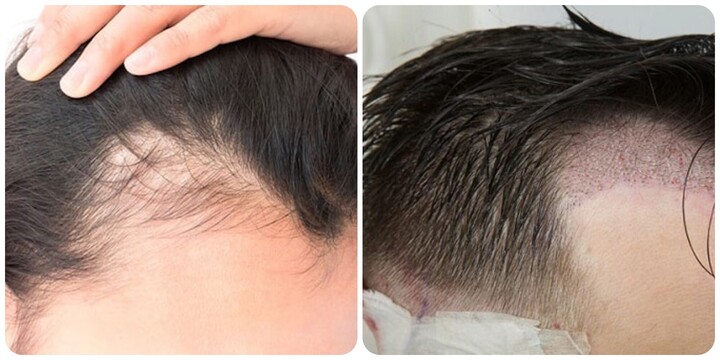 Cấy tóc có an toàn không?