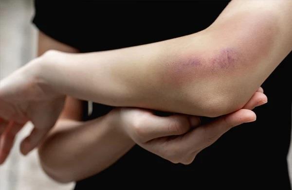 Dấu hiệu cảnh báo bệnh ung thư máu dễ bị bỏ qua