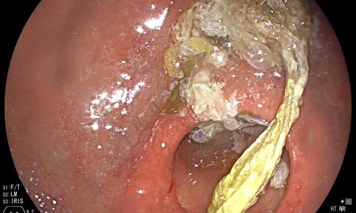 Người đàn ông suy kiệt vì bã thức ăn dài 20cm trong dạ dày