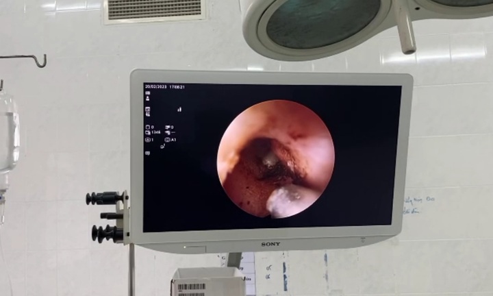 Ve chó chui vào tai bé trai 8 tuổi