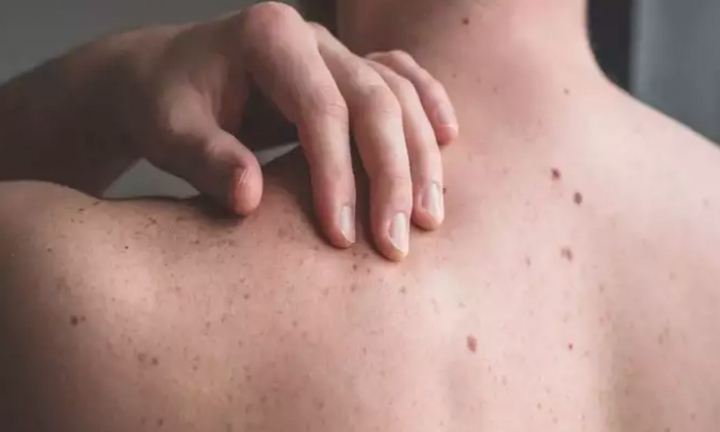 Dấu hiệu ung thư da giai đoạn đầu