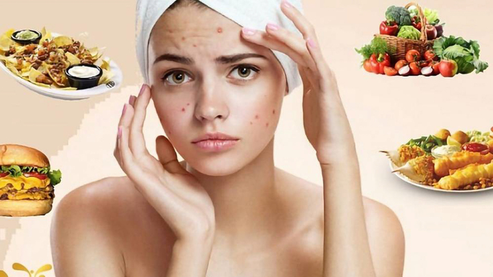 Người bị mụn không nên ăn gì?