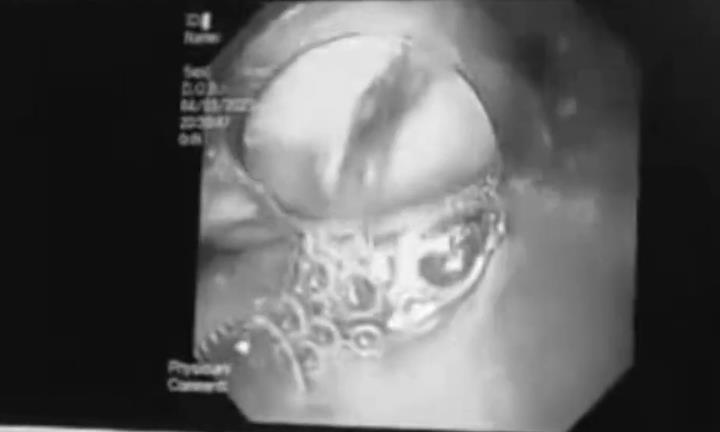 Nuốt mật lợn chữa đau bụng theo dân gian, người phụ nữ nguy kịch