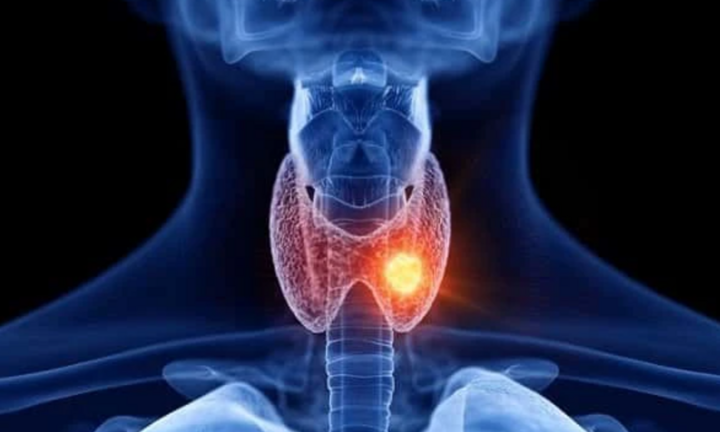 Làm gì để phòng ngừa ung thư tuyến giáp hiệu quả nhất?