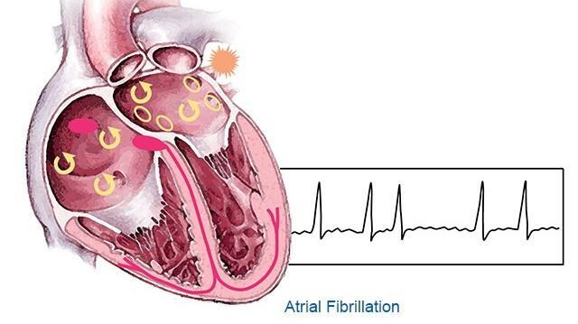 Biện pháp giảm nguy cơ mắc bệnh rung tâm nhĩ