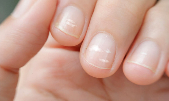 Móng tay bị rỗ là bệnh gì?