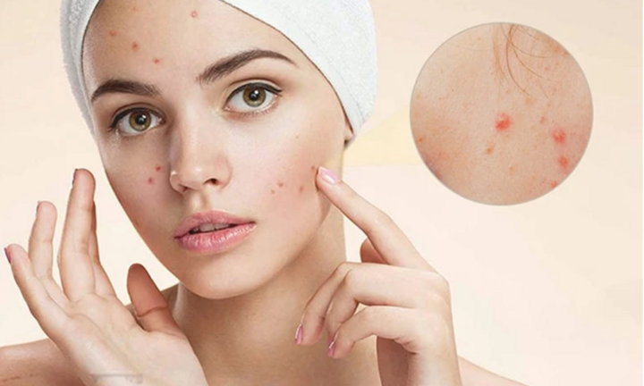 Điều trị mụn trứng cá hiệu quả nhất, không để lại di chứng trên da