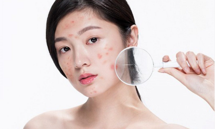 Mụn trứng cá gây thâm rỗ mặt: Bác sĩ da liễu mách cách chăm sóc da tốt nhất