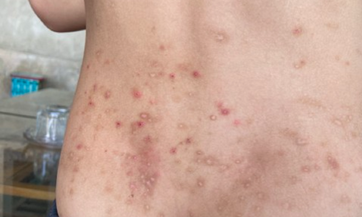 Hàng trăm người ở Hà Tĩnh bị bọ chét đốt gây sẩn ngứa khắp người