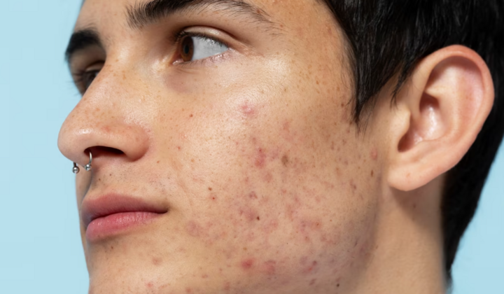 Bị mụn trứng cá, ăn gì để nhanh khỏi?