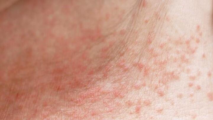 Cha mẹ nên làm gì khi trẻ mắc ban nóng, rôm sảy?