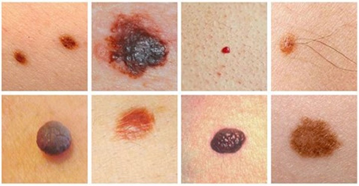 Tẩy nốt ruồi có kích thích tế bào ung thư phát triển không?