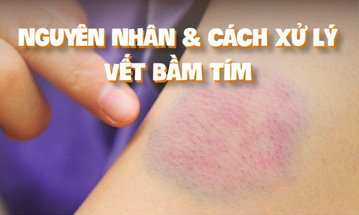 8 nguyên nhân dẫn đến vết bầm tím trên da