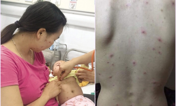 Mắc thủy đậu phải kiêng nước, kiêng gió, có đúng không?