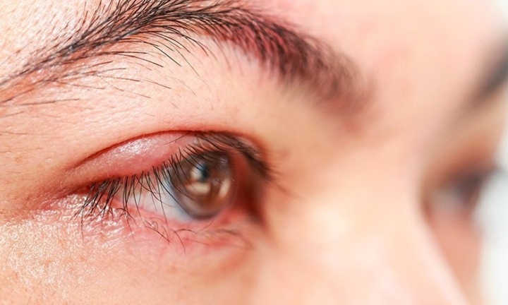 Người bị đau mắt cần kiêng ăn những thực phẩm sau