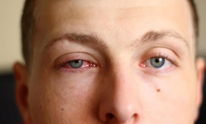 Khi bị đau mắt thì nên kiêng ăn gì?