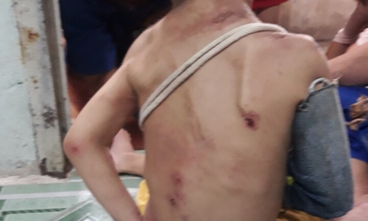 Bé trai ở TP.HCM có dấu hiệu bị bạo hành: Người mẹ thừa nhận đánh con