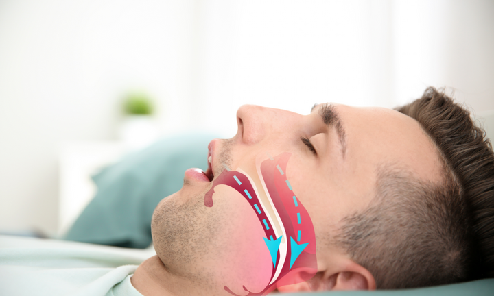 Ngủ chảy nước miếng là dấu hiệu của bệnh gì?